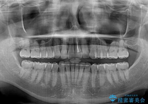 前歯のデコボコを治したい インビザラインによる矯正治療の治療後
