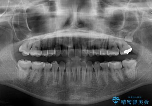 インビザラインでスッキリとした口元にの治療後