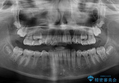埋もれた犬歯を引っ張り出す　小学生のⅠ期治療の治療後