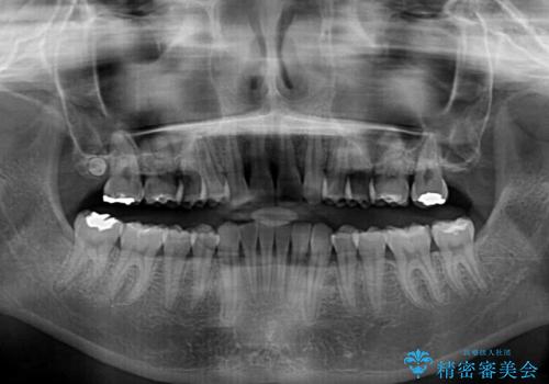 上顎前歯が2本欠損 インビザラインによる叢生の解消の治療後