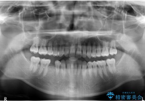 すきっ歯・出っ歯が気になる　インビザライン矯正　乳歯をインプラントにの治療中