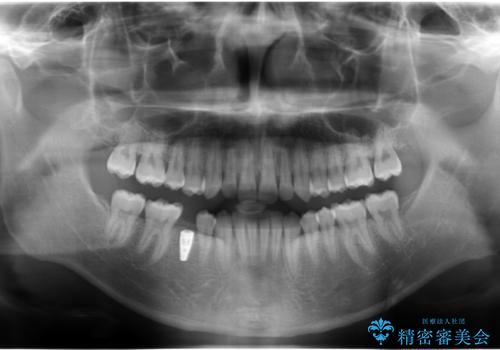 20代男性 奥歯のインプラント 自分の骨を移植の治療後