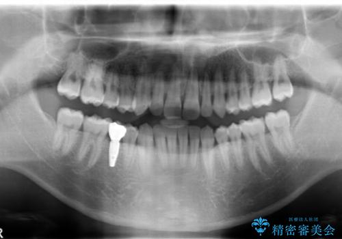 すきっ歯・出っ歯が気になる　インビザライン矯正　乳歯をインプラントにの治療後