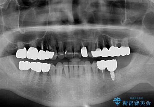 歯列不正と歯周病　総合歯科治療による全顎治療の治療後