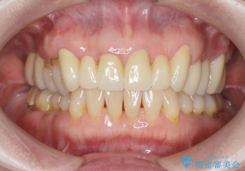 不自然な前歯ブリッジ ジルコニアブリッジによるやり替えの治療後