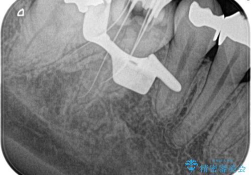 【根管治療】昨日から眠れないぐらい歯が痛いの治療前