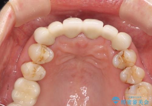 不自然な前歯ブリッジ ジルコニアブリッジによるやり替えの治療前