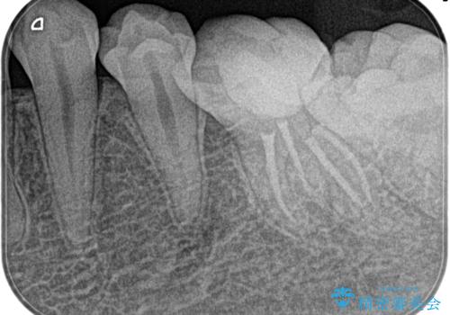 【根管治療】冷たいもので激痛の治療後