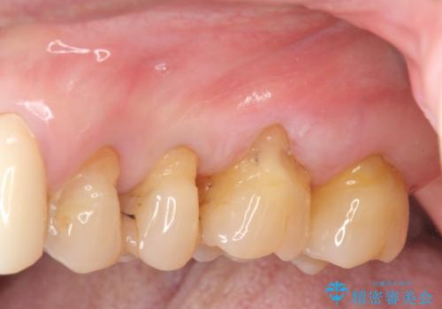 歯ぎしりに抵抗する歯周補綴 インプラント補綴の症例 治療前