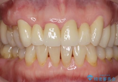 不自然な前歯ブリッジ ジルコニアブリッジによるやり替えの治療後