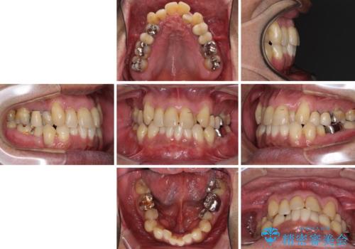歯列不正と歯周病 総合歯科治療による全顎治療の治療前