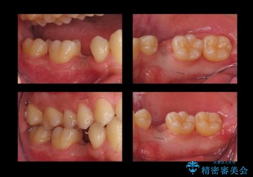 20代男性 奥歯のインプラント 自分の骨を移植の治療中