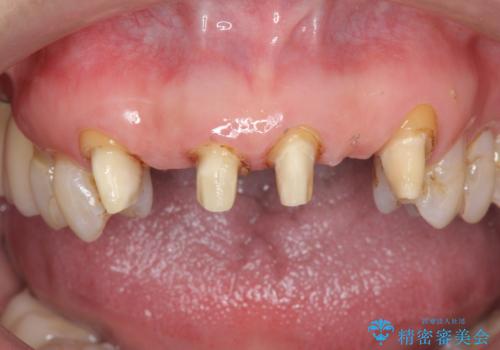 不自然な前歯ブリッジ ジルコニアブリッジによるやり替えの治療中