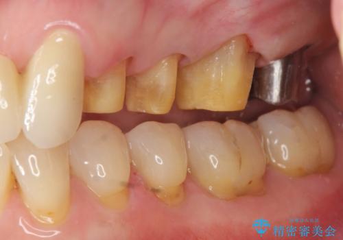 歯ぎしりに抵抗する歯周補綴 インプラント補綴の治療中