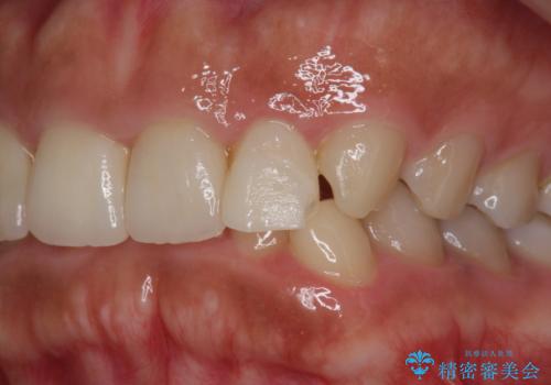 割れにくいセラミック治療 フルジルコニアクラウンの治療前