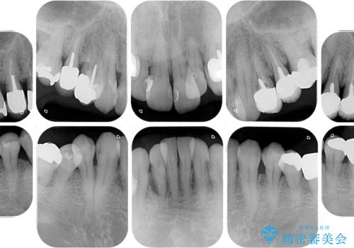 歯列不正と歯周病 総合歯科治療による全顎治療の治療前