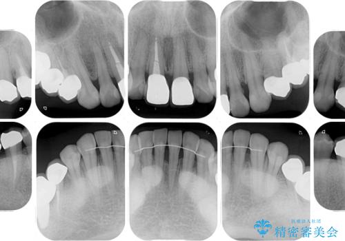 気になる部分を全て治療　総合歯科治療で口腔内環境改善の治療後