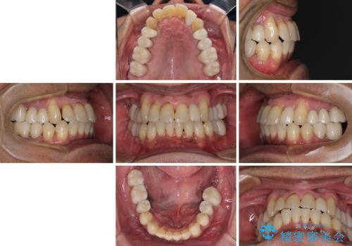 歯列不正と歯周病　総合歯科治療による全顎治療の治療後