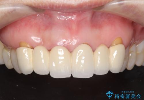 不自然な前歯ブリッジ ジルコニアブリッジによるやり替えの治療前