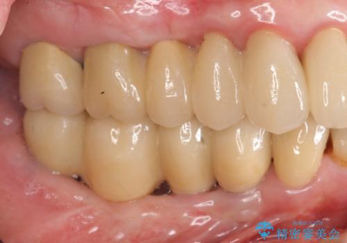 重度の虫歯 インプラント治療の症例 治療後