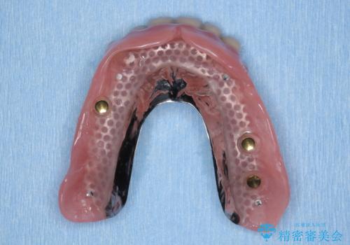 「しっかり噛める入れ歯」インプラントオーバーデンチャーの治療中