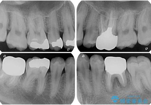 銀歯を白くしたい セラミックによる審美歯科治療の治療前