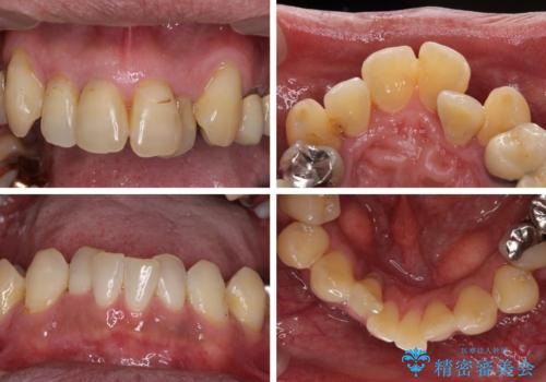 歯列不正と歯周病　総合歯科治療による全顎治療の治療前