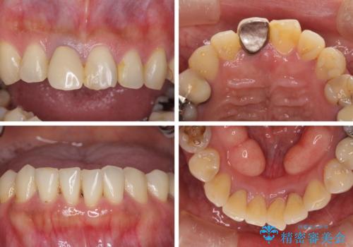 気になる部分を全て治療　総合歯科治療で口腔内環境改善の治療前