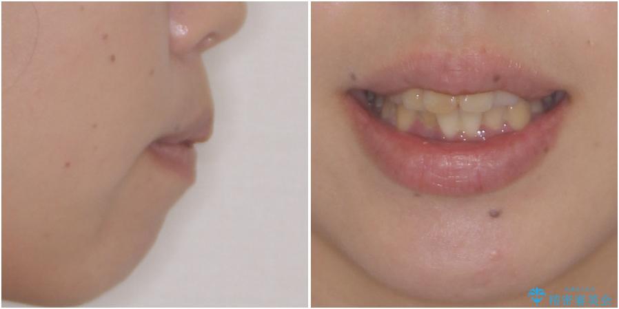 口元の突出感を改善 ワイヤー装置による抜歯矯正の治療前(顔貌)