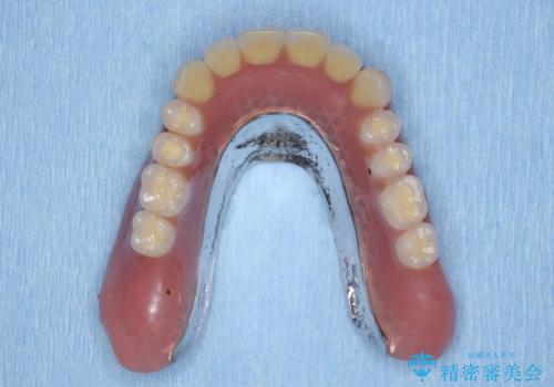 「しっかり噛める入れ歯」インプラントオーバーデンチャーの治療中