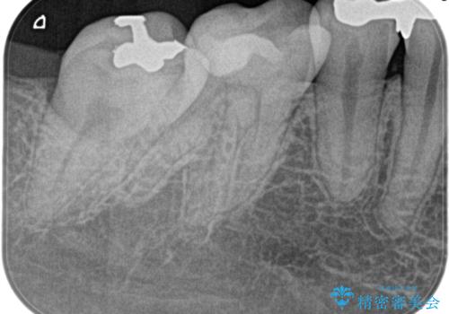 【根管治療】昨日から眠れないぐらい歯が痛いの治療前