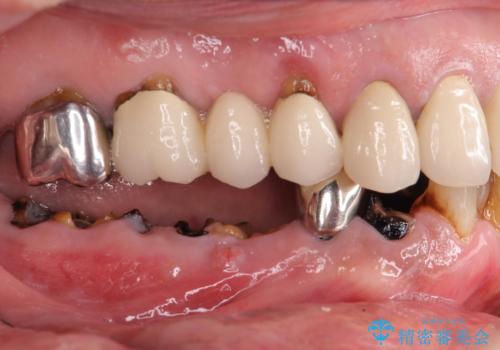 重度の虫歯　インプラント治療の症例 治療前