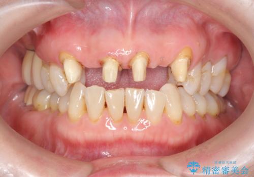 不自然な前歯ブリッジ ジルコニアブリッジによるやり替えの治療中