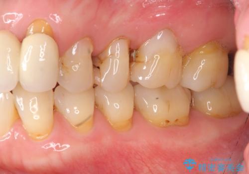 歯ぎしりに抵抗する歯周補綴 インプラント補綴の治療前