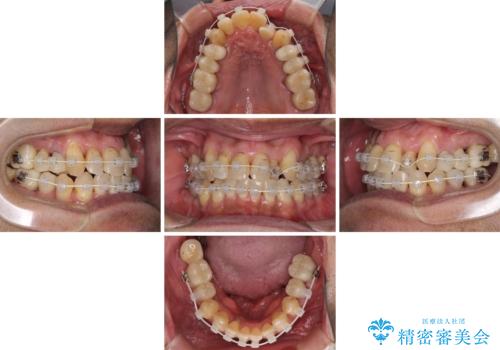歯列不正と歯周病 総合歯科治療による全顎治療の治療中