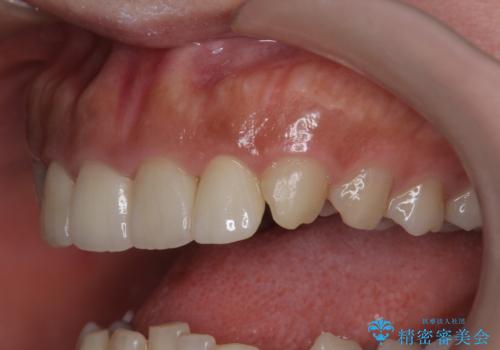 割れにくいセラミック治療 フルジルコニアクラウンの治療後