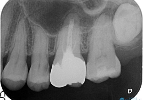 金属をセラミックにしたい、根管治療も行ったケースの治療前