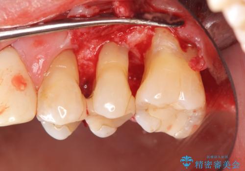 歯ぎしりに抵抗する歯周補綴 インプラント補綴