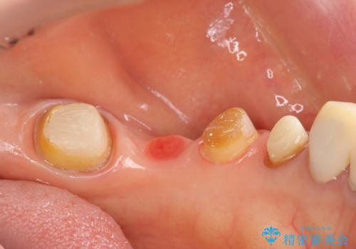 清掃しづらく、見た目の気になるブリッジの治療中