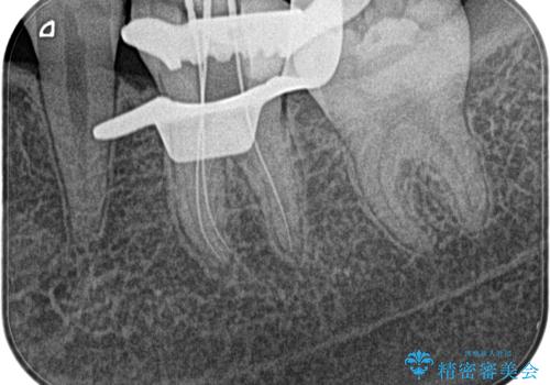 【根管治療】冷たいもので激痛の治療前