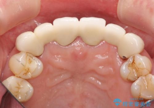 不自然な前歯ブリッジ ジルコニアブリッジによるやり替えの治療前
