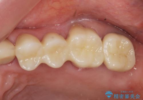 歯ぎしりに抵抗する歯周補綴 インプラント補綴の治療後