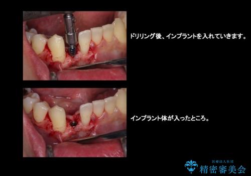 下の前歯のインプラント　生まれつき歯が少ないの治療中