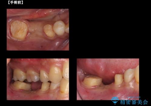 虫歯がひどく抜歯 奥歯をブリッジにの治療中