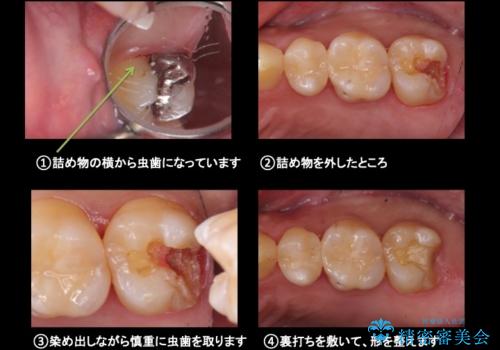 奥歯の詰め物のやりかえ セラミックインレー、ゴールドインレーの治療中