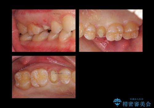 歯の高さがなく、しょっちゅう外れる 他院で治療途中だが病院を変えたいの治療中