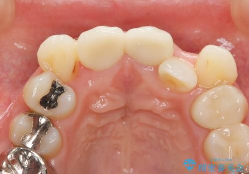 子供の頃にぶつけた前歯 根管治療から行うセラミック治療の治療後