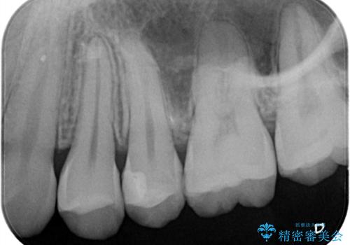 【セラミックインレー】虫歯の治療の治療後