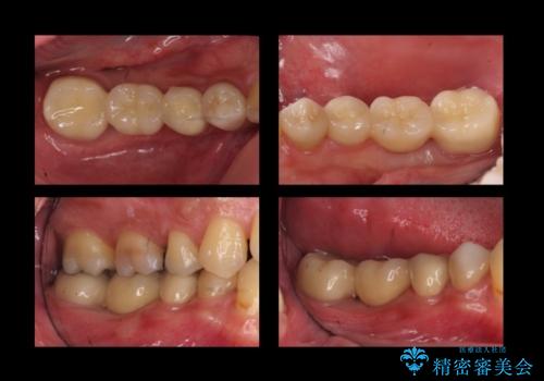 虫歯がひどく抜歯 奥歯をブリッジにの症例 治療後