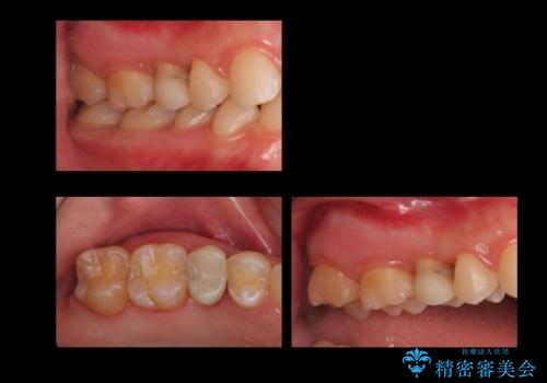歯の高さがなく、しょっちゅう外れる 他院で治療途中だが病院を変えたいの治療中